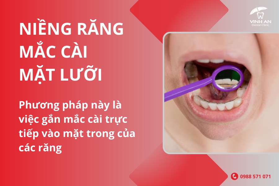 Niềng Răng Thẩm Mỹ