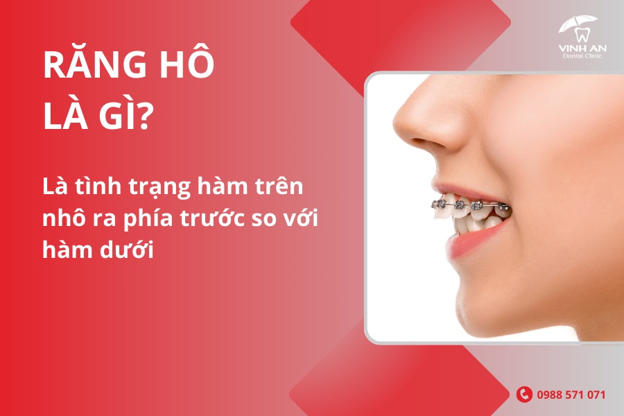 Niềng Răng Thẩm Mỹ