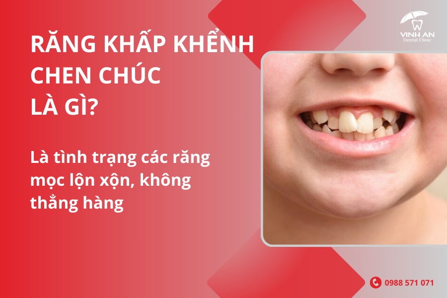 Niềng Răng Thẩm Mỹ