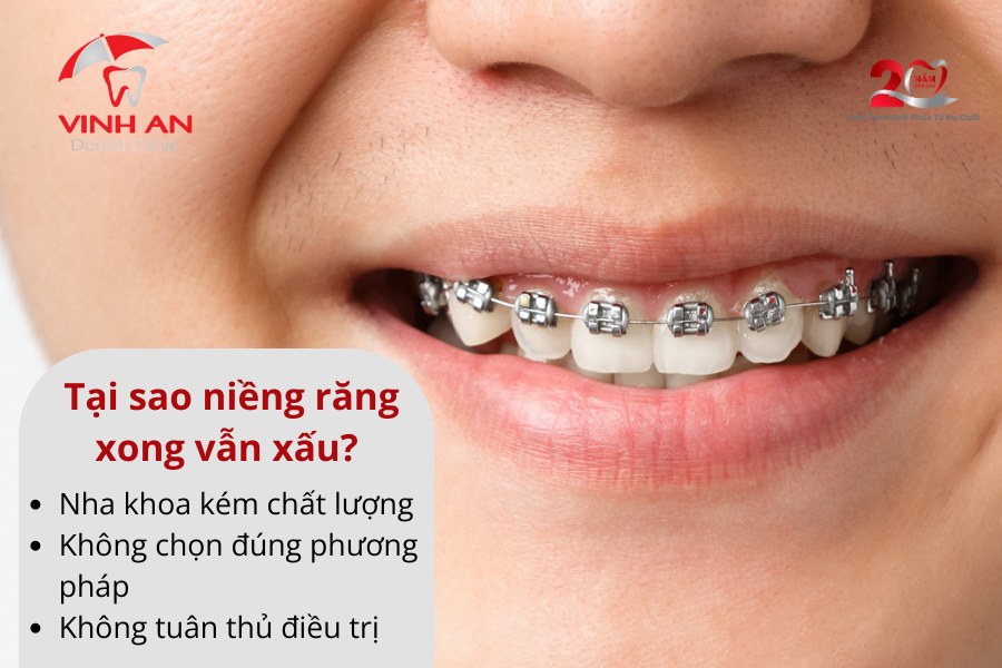 Niềng Răng Xong Vẫn Xấu