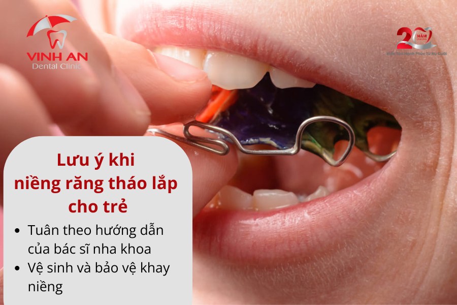 Niềng Răng Tháo Lắp Trẻ Em Là Gì