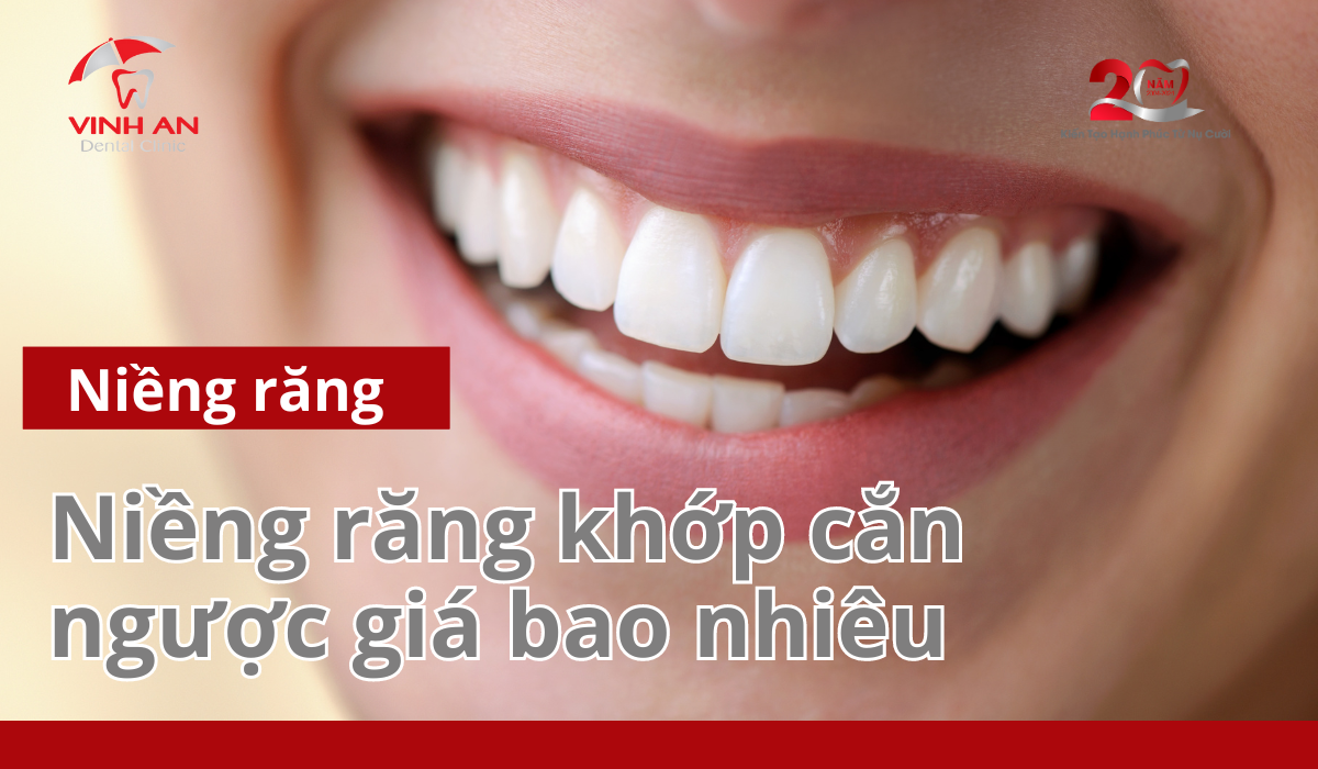 Niềng răng khớp cắn ngược