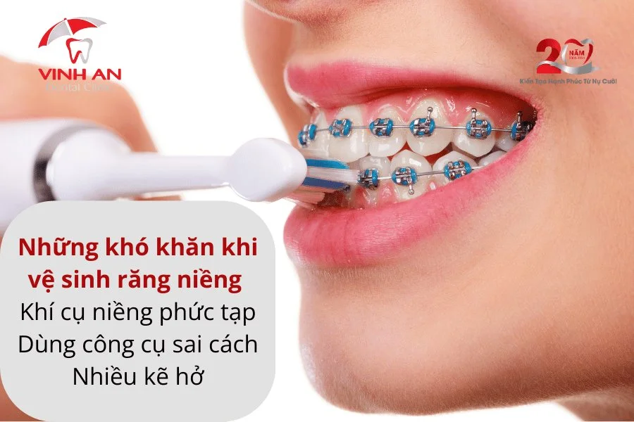 Vệ sinh răng niềng.