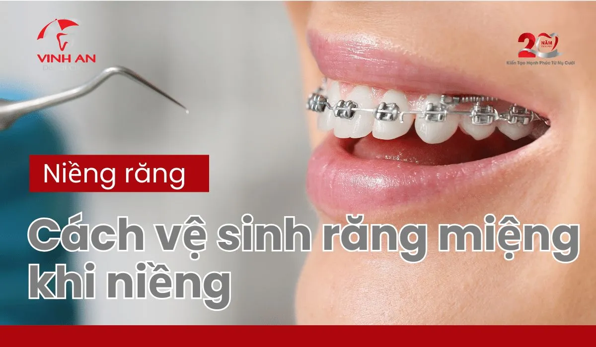 Vệ sinh răng niềng.