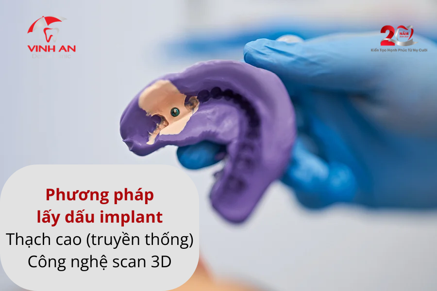 Lấy Dấu Implant