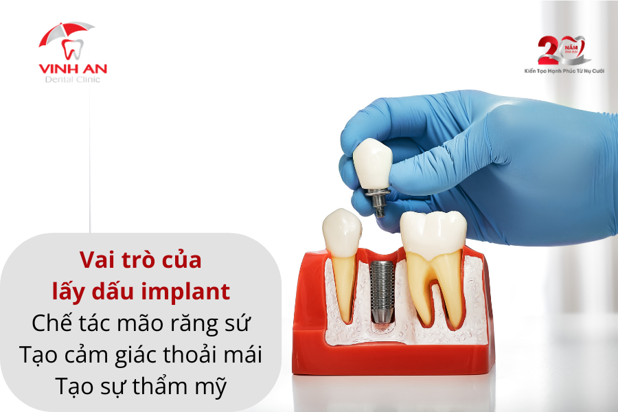 Lấy Dấu Implant