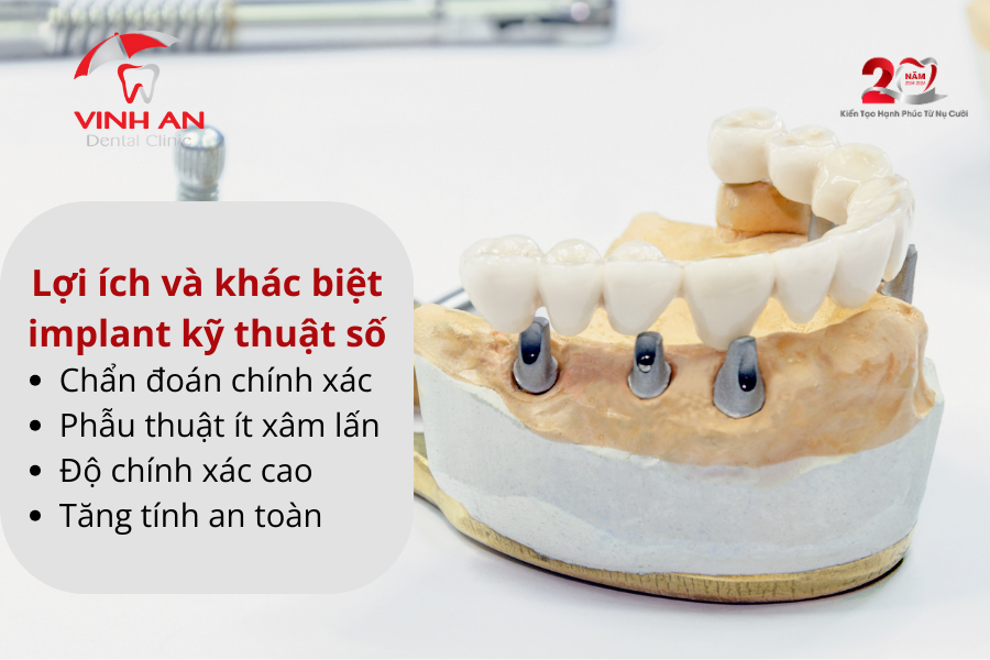 Implant Ky Thuat So