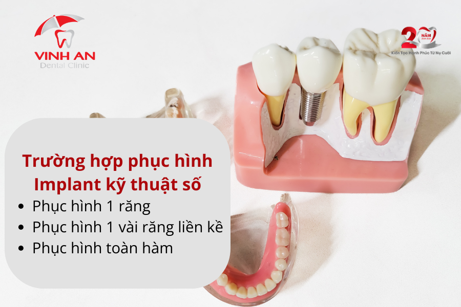 Implant Ky Thuat So