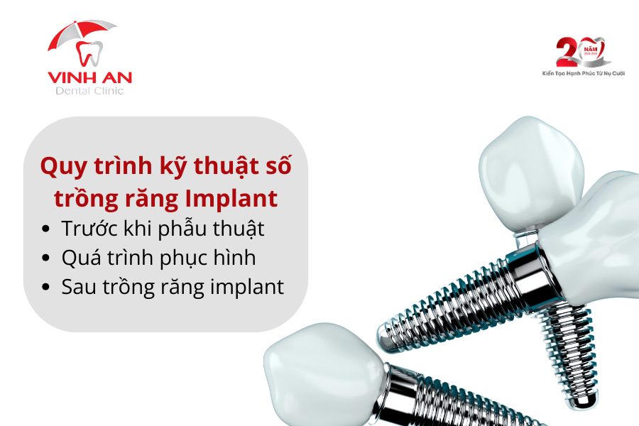 Implant Ky Thuat So