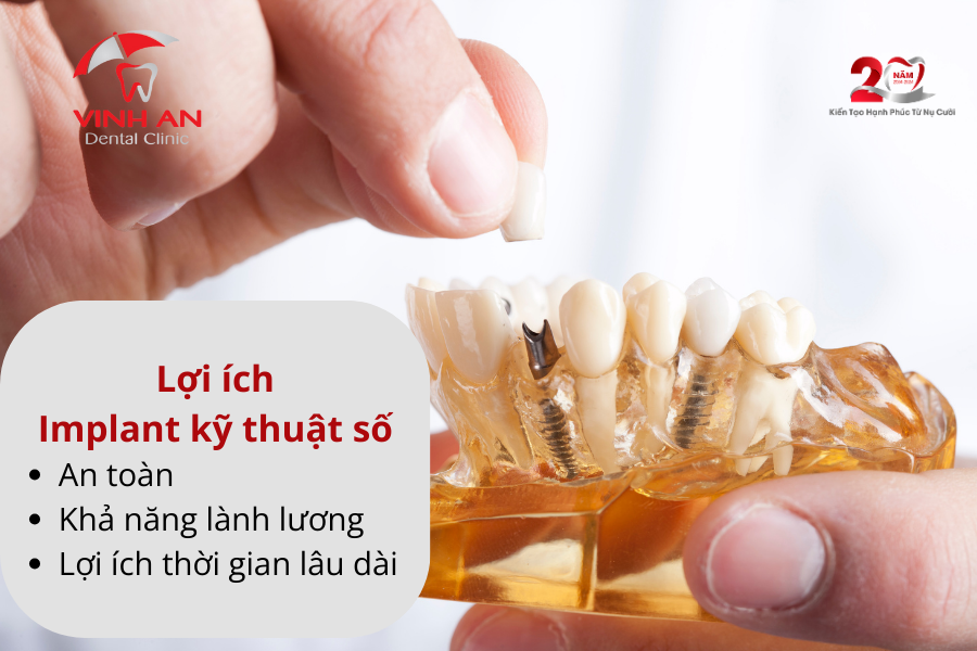 Implant Ky Thuat So