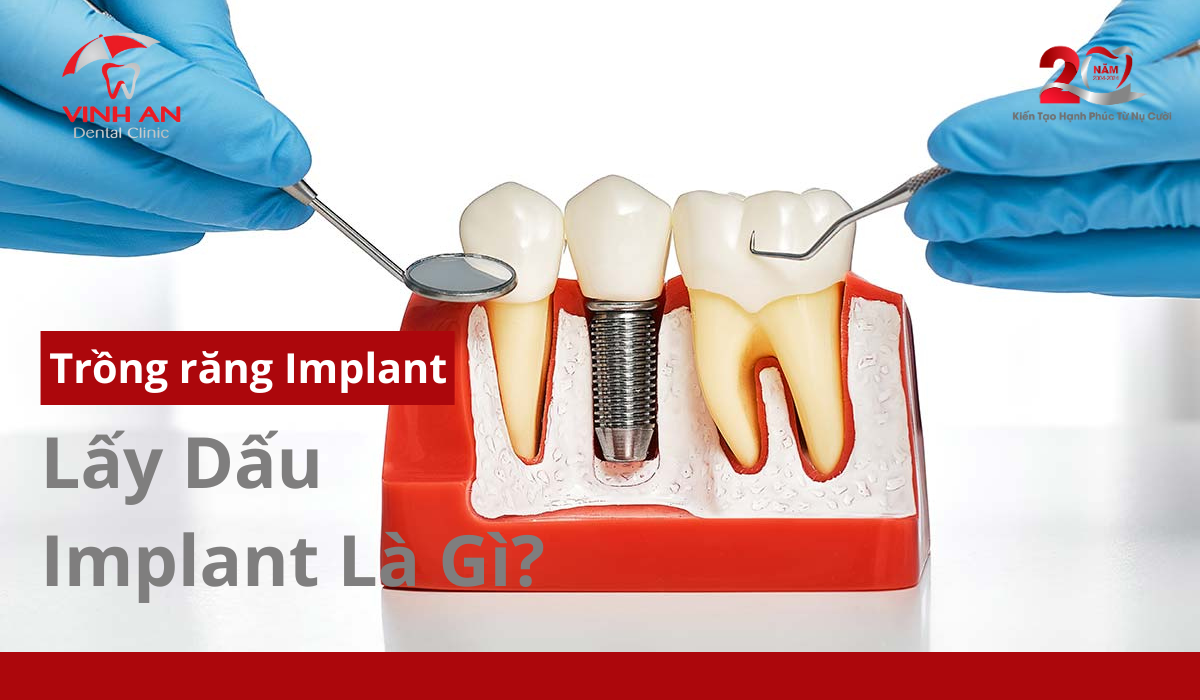 Lay-dau-implant