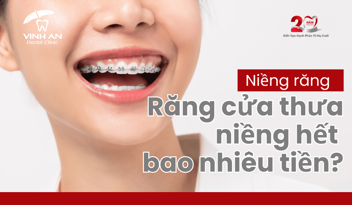 Niềng răng cửa thưa hết bao nhiêu tiền