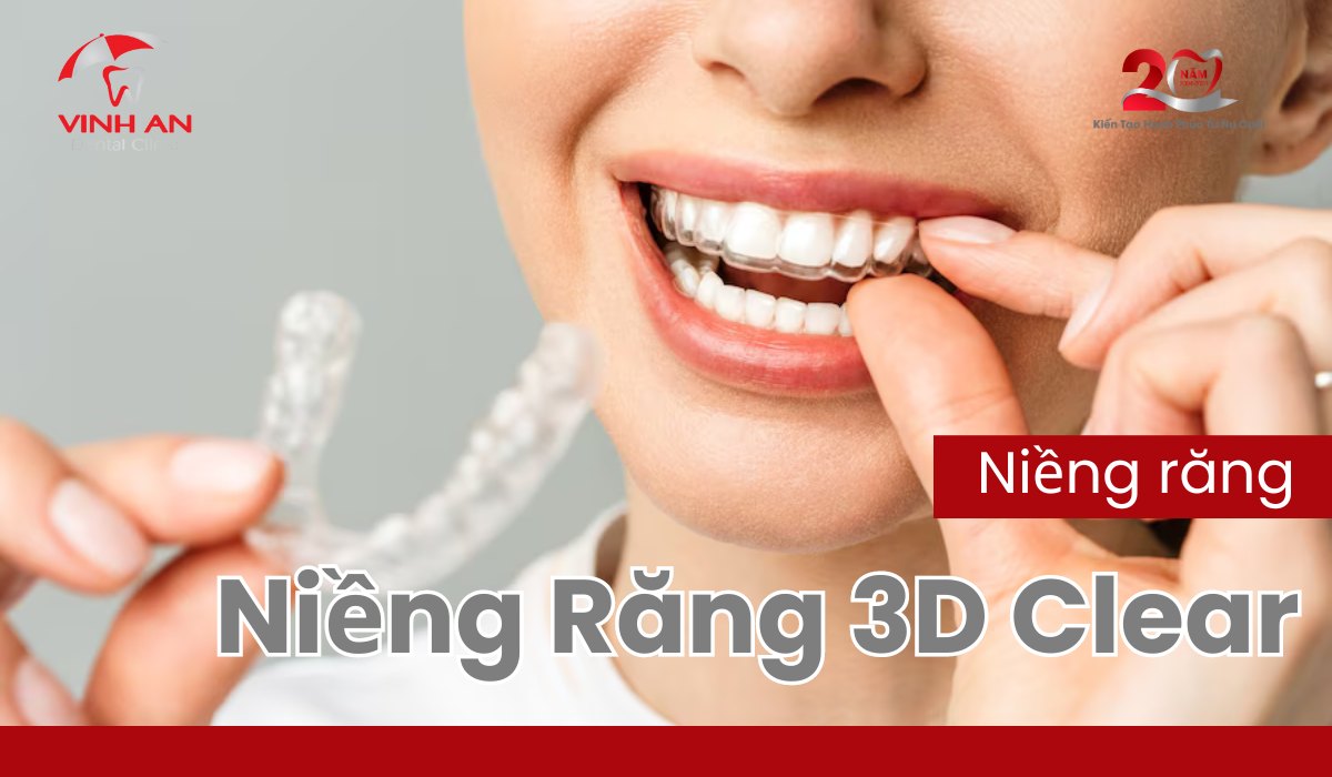 Niềng Răng 3d Clear Là Gì - Thumbnail