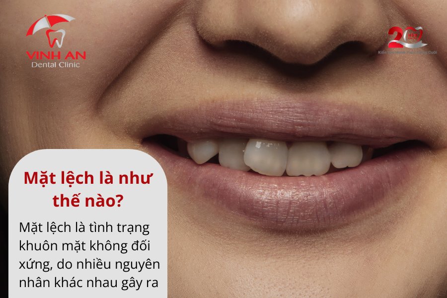 Niềng Răng Có Hết Lệch Mặt Không