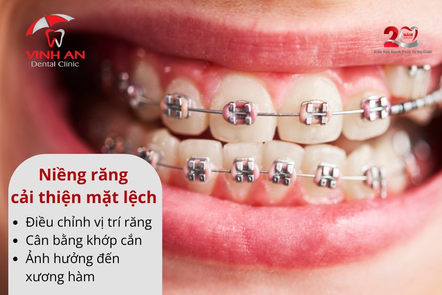 Niềng Răng Có Hết Lệch Mặt Không