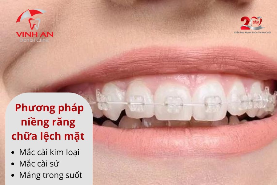 Niềng Răng Có Hết Lệch Mặt Không