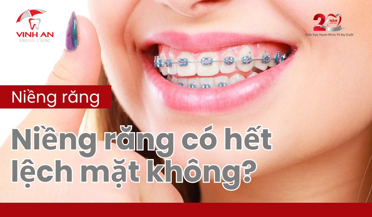Niềng Răng Có Hết Lệch Mặt Không - Thumnail