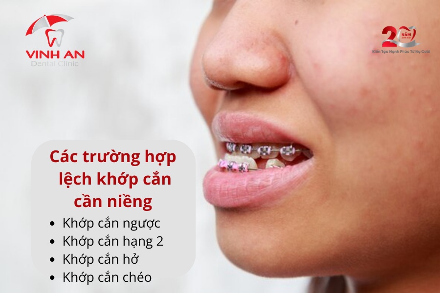 Niềng Răng Lệch Khớp Cắn 2
