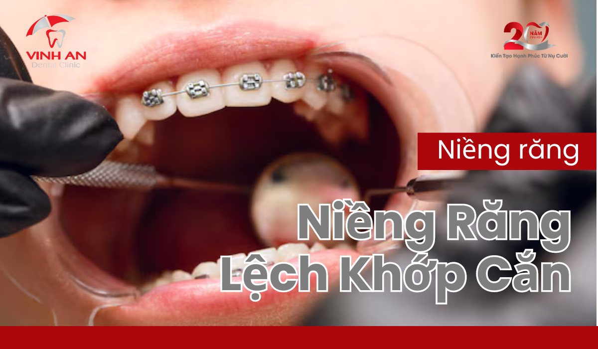 Niềng Răng Lệch Khớp Cắn - Thumbnail