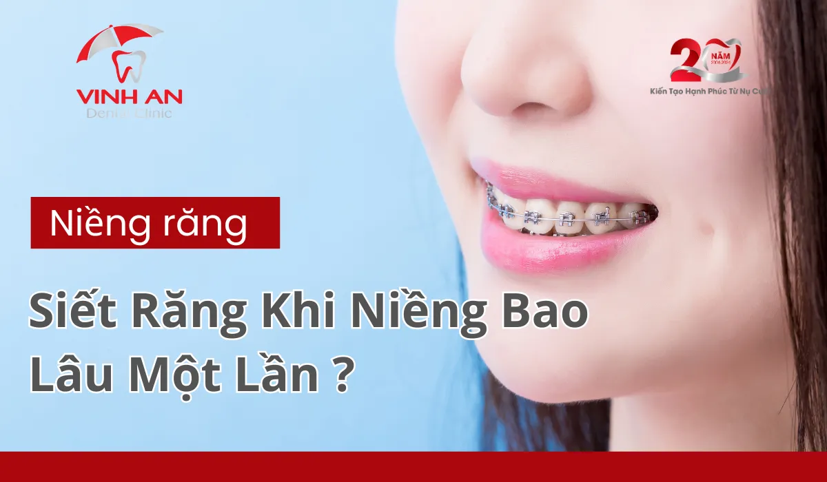 Siết Răng Khi Niềng Là Gì