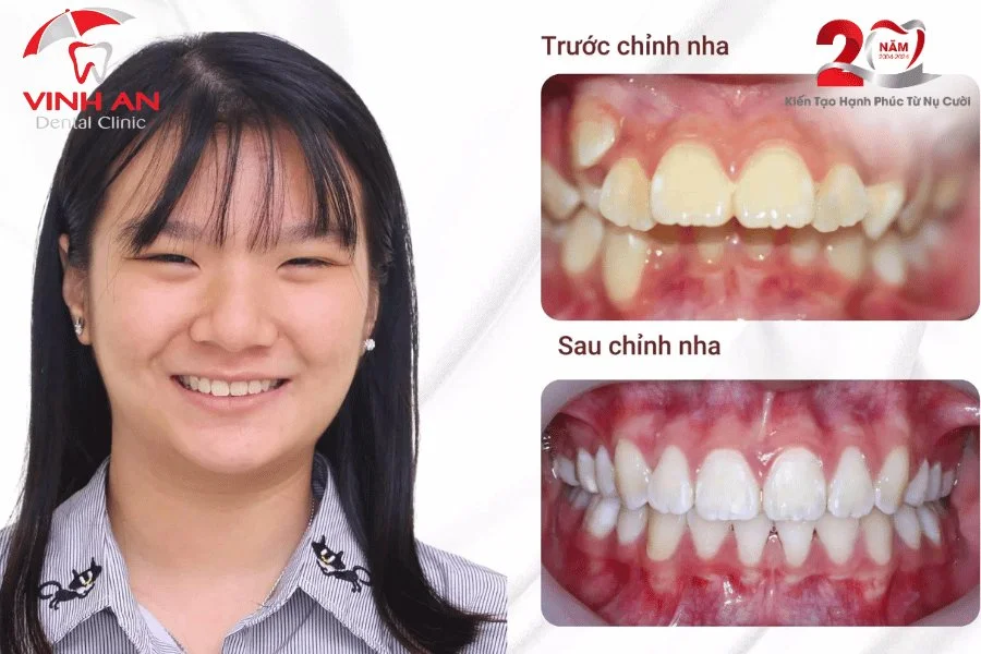 Ho-ham-co-nieng-rang-duoc-khong-5