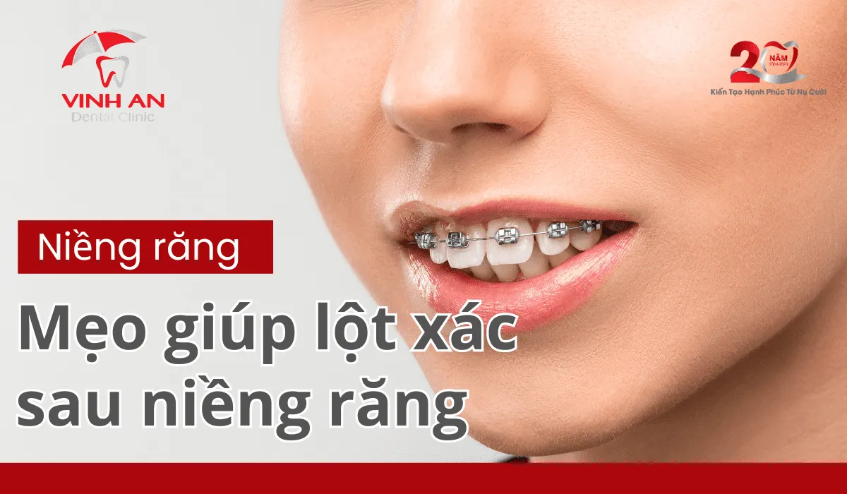 Lột Xác Sau Niềng Răng (1)_1