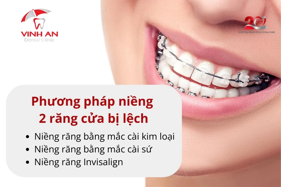 Niềng 2 Răng Cửa Bị Lệch