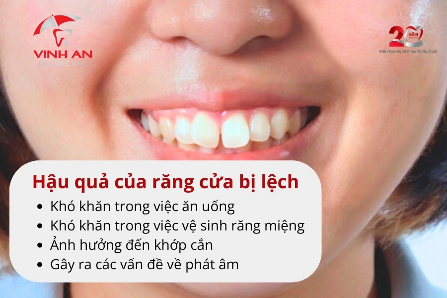 Niềng 2 Răng Cửa Bị Lệch