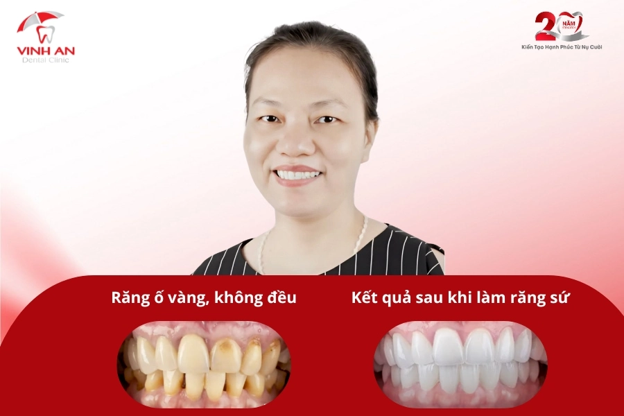 Khách hàng làm răng sứ toàn hàm