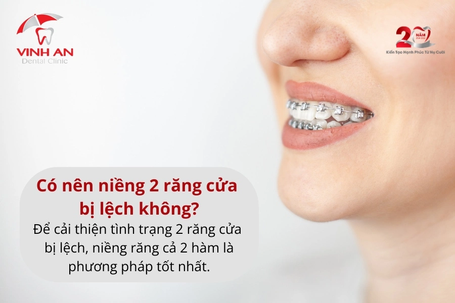Niềng 2 răng cửa bị lệch