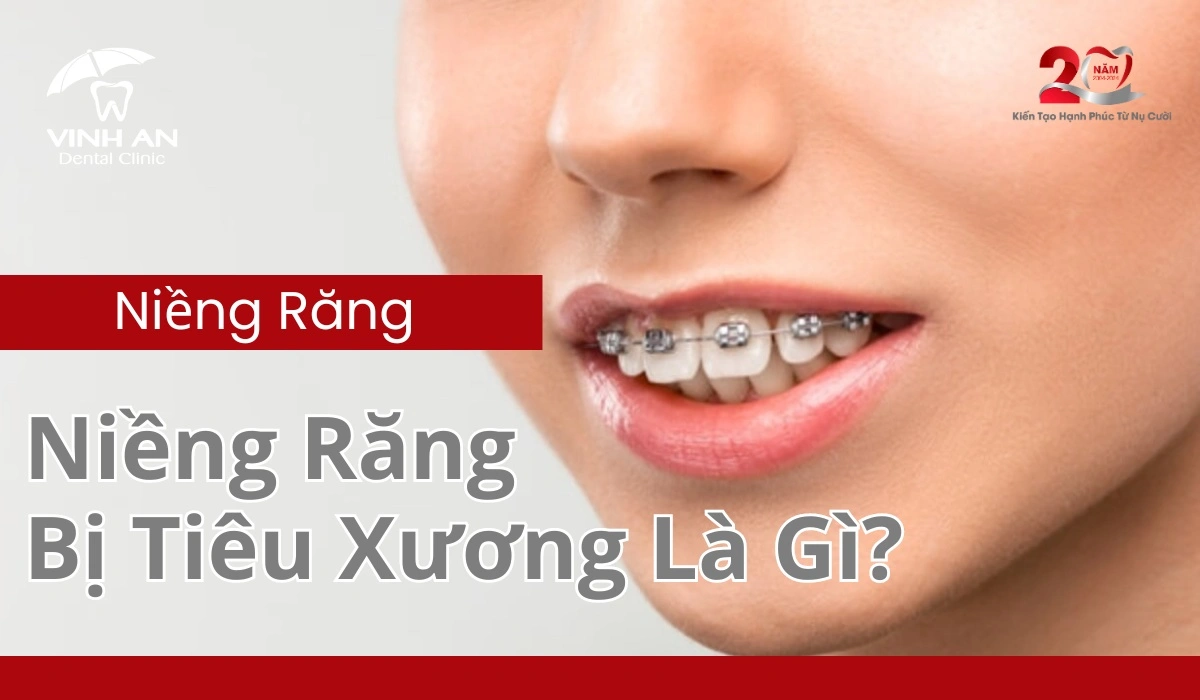 Niềng Răng Bị Tiêu Xương-compressed