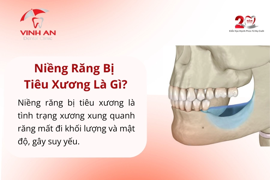 Niềng Răng Bị Tiêu Xương