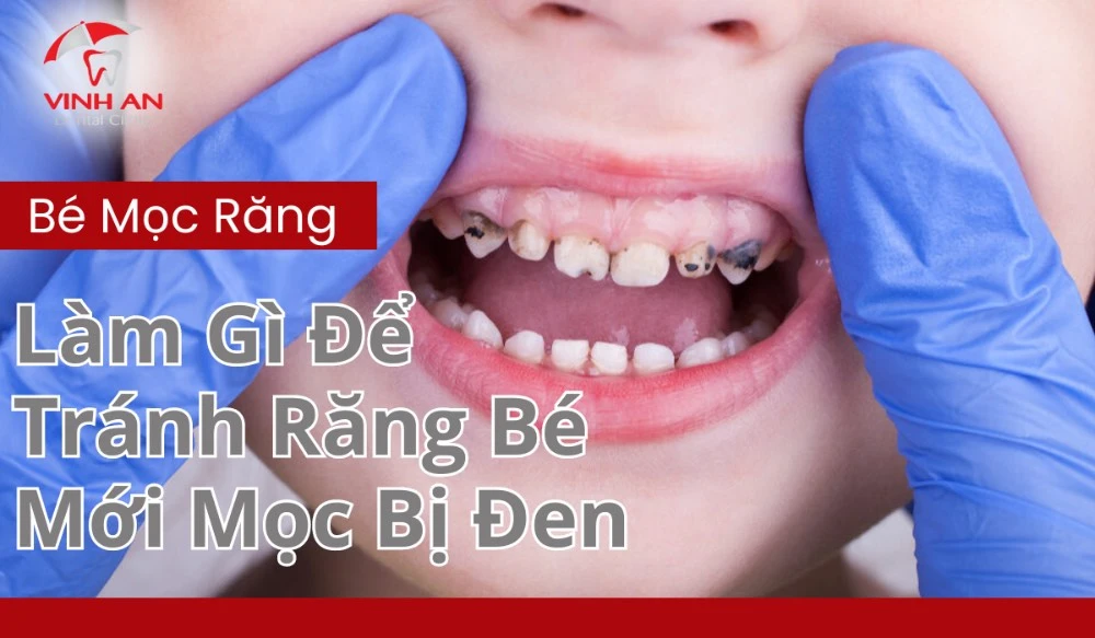 Trẻ Mới Mọc Răng đã Bị đen