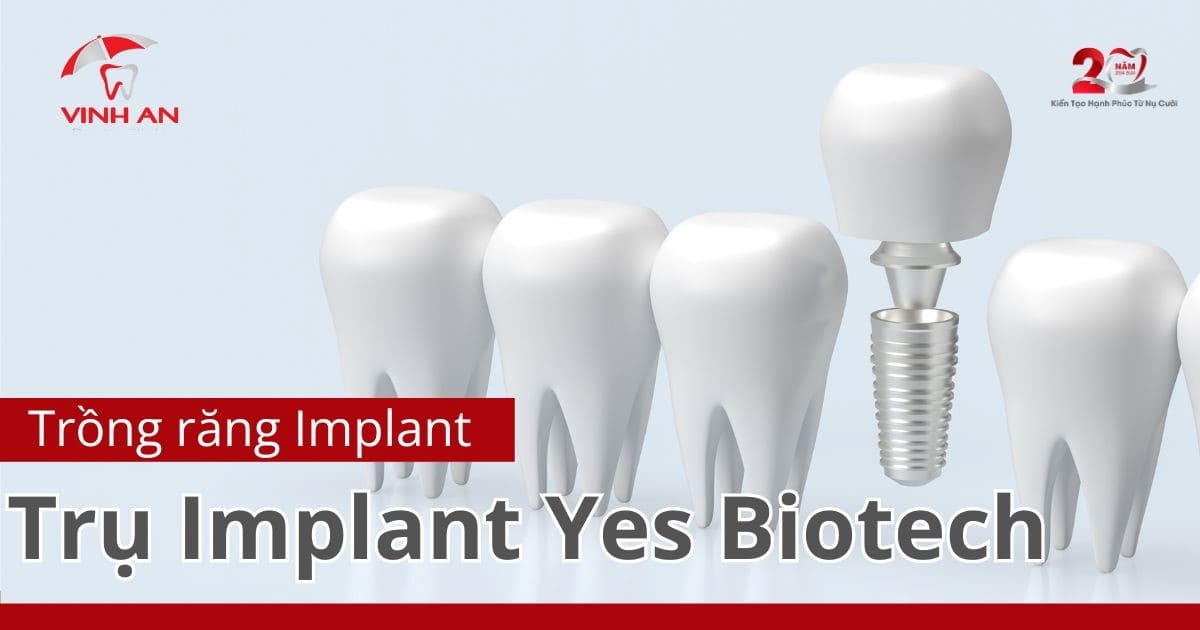 Trụ Implant Yes Biotech có tốt không? Xuất xứ, giá cả1