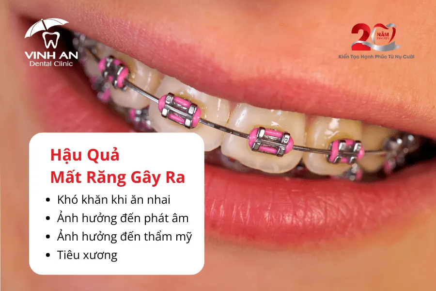 Mất Răng Có Niềng Răng được Không4