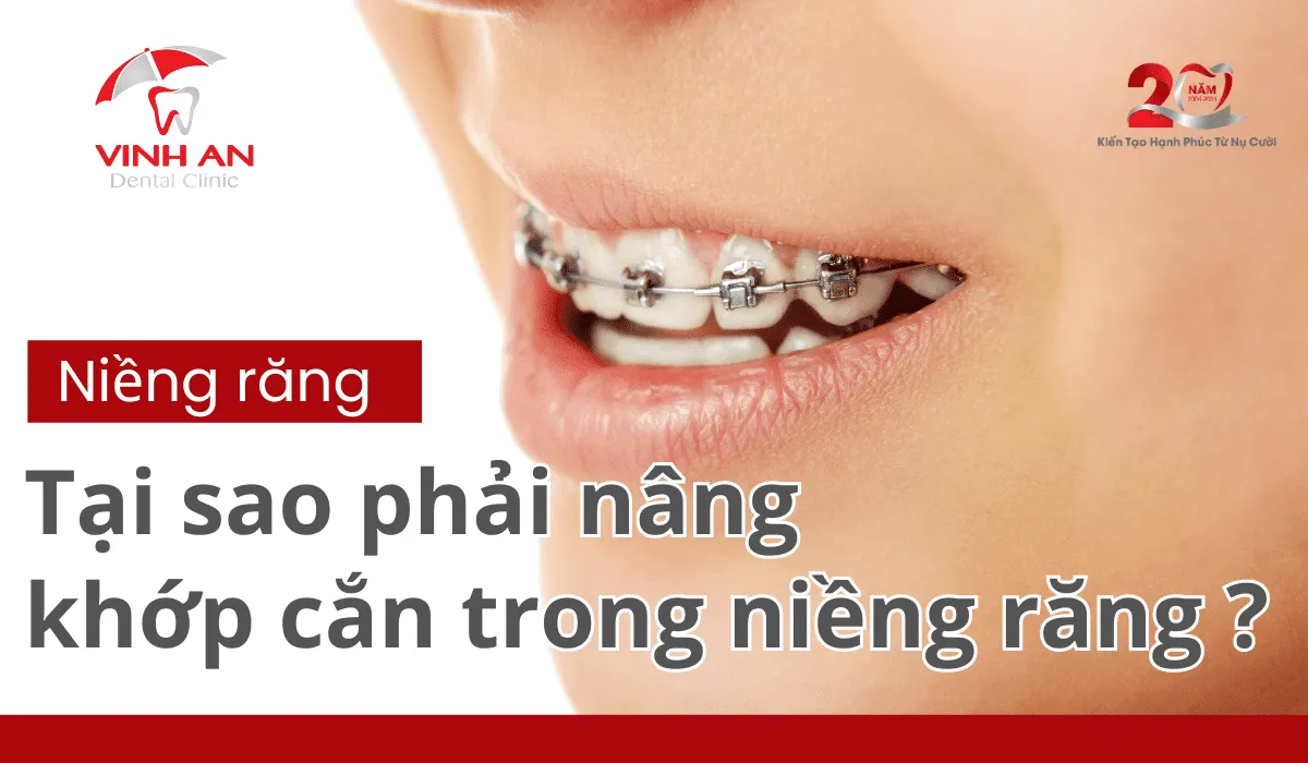 Nâng Khớp Cắn Trong Niềng Răng