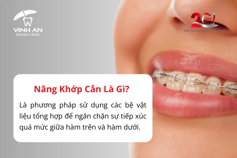 Nâng Khớp Cắn Trong Niềng Răng1