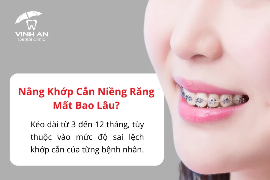 Nâng Khớp Cắn Trong Niềng Răng4
