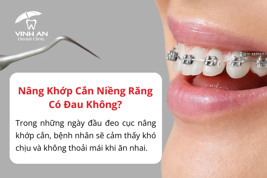 Nâng Khớp Cắn Trong Niềng Răng5