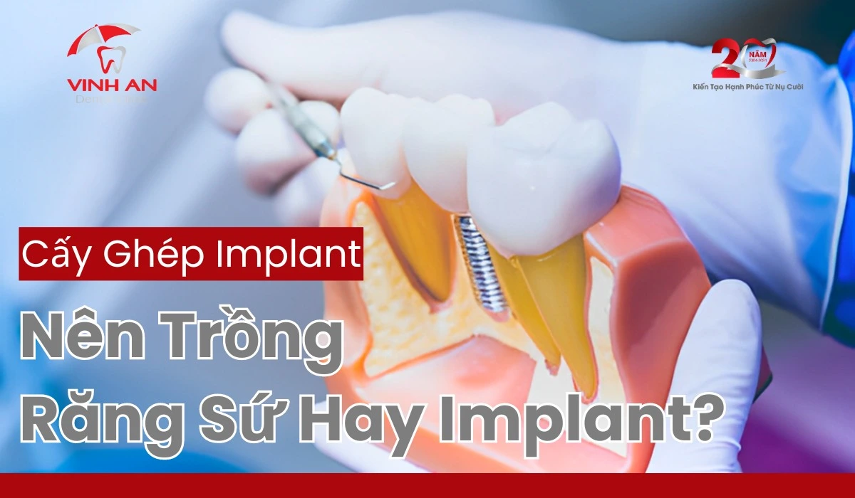 Nên-trồng-răng-sứ-hay-implan