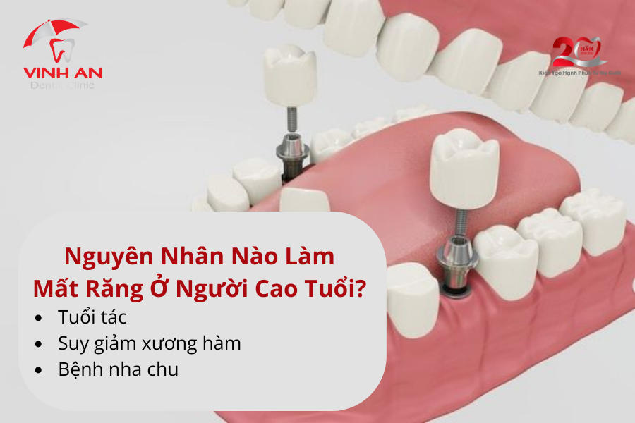 Trong-rang-implant-cho-nguoi-cao-tuoi (2)