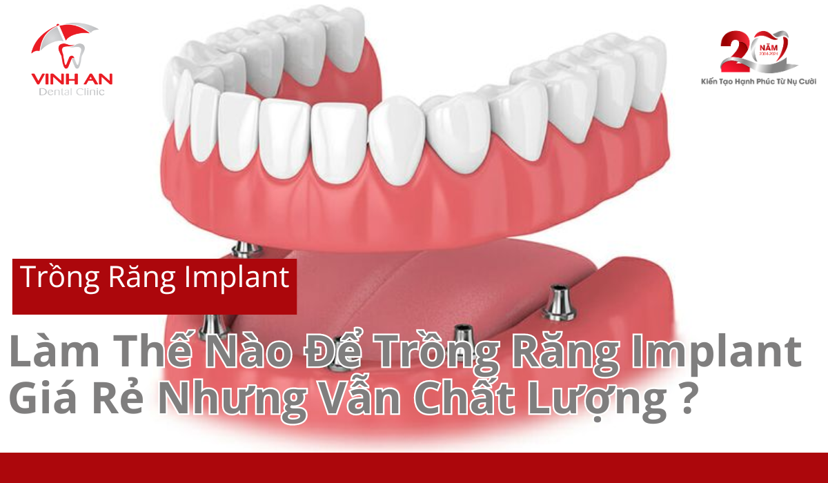 Trong-rang-implant-gia-re