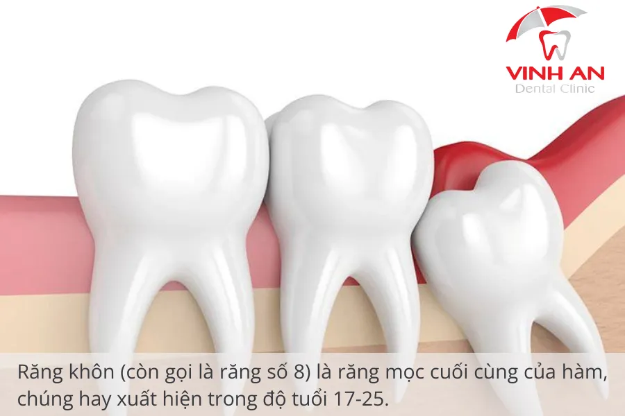 Răng khôn hay còn gọi là răng số 8 mọc ở người trưởng thành