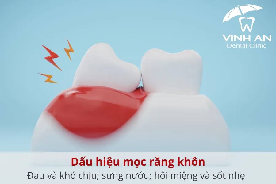 Những dấu hiệu nhận biết trong quá trình mọc răng khôn