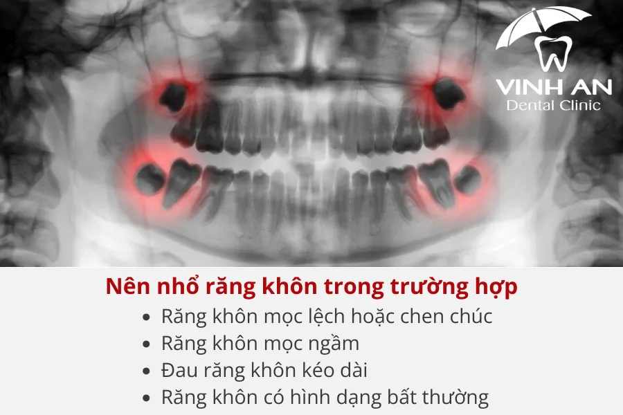 Một số trường hợp bác sĩ khuyên nên nhổ răng khôn