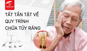 Quy trình chữa tủy răng