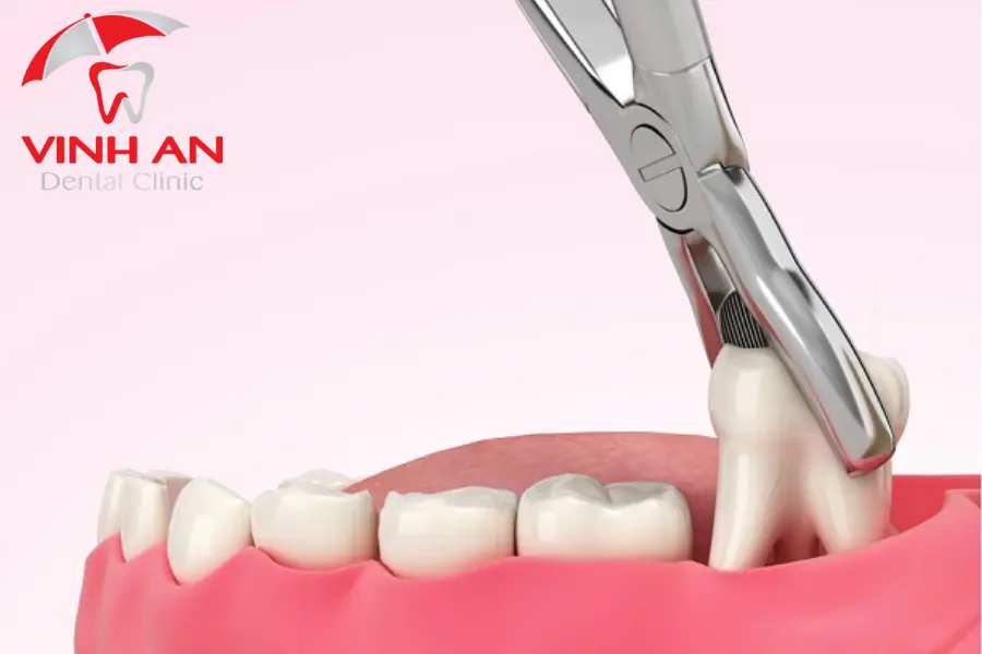 Bảo vệ sức khỏe thần kinh ở hàm mặt