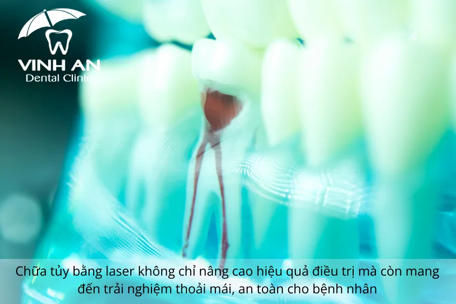 Chua-tuy-rang-bang-laser-2
