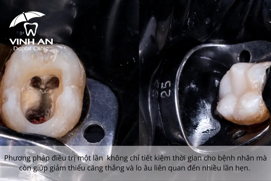 Lay-tuy-rang-6