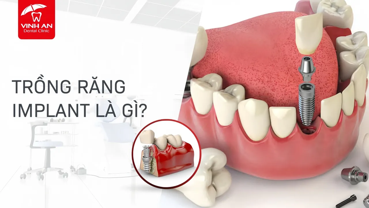 Trong-rang-implant (1)